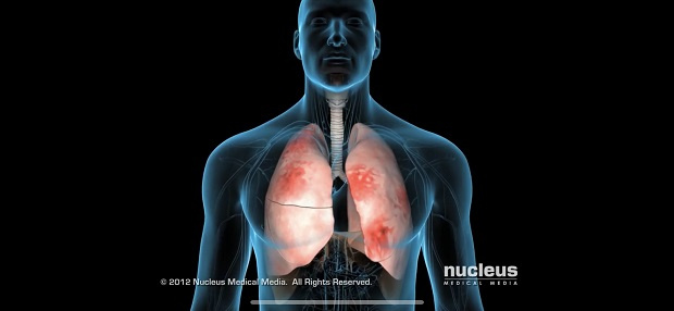 Видео разкрива увреждане на белите дробове при пациент с коронавирус