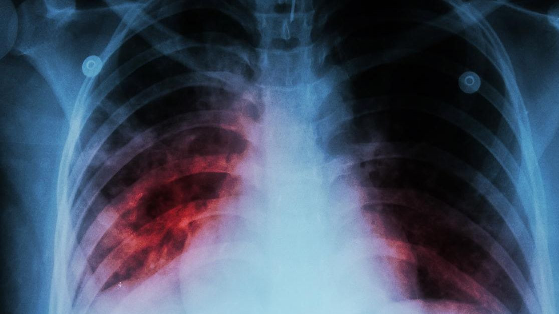 СЗО предупреждава за бум на туберкулоза за първи път от години