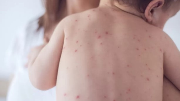 Какво е морбили и колко е опасно