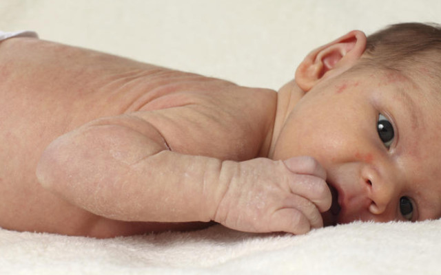 Атопичен дерматит и какво трябва да знаем за него