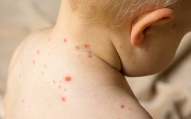 МЗ: Възможни са взривове от морбили в страната