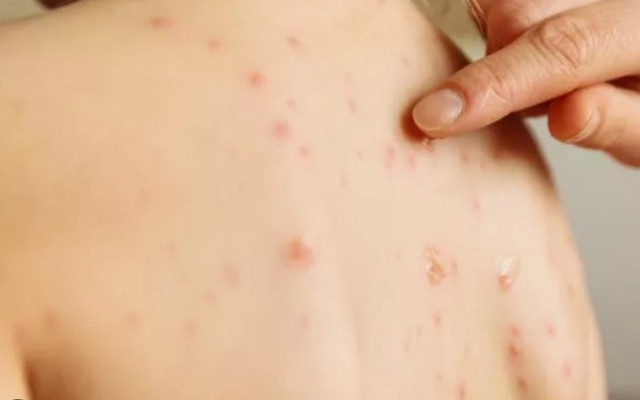 Защо морбили се завръща и има ли риск от епидемия в България