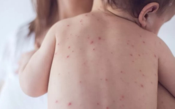 Какво е морбили и колко е опасно