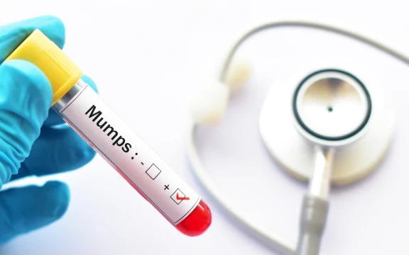 Нови случаи на заразени с морбили в областите Враца и Плевен