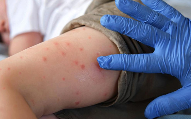 Нови случаи на морбили в Ловешко