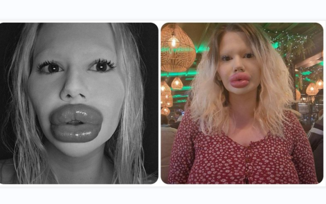 Българското Барби: Може да ослепея от хиалурона, но няма да спра!