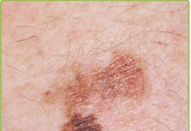 Риск за рак на кожата – не всички сме равни пред слънцето!
