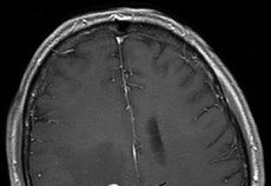 Симптоми и белези на мозъчните тумори