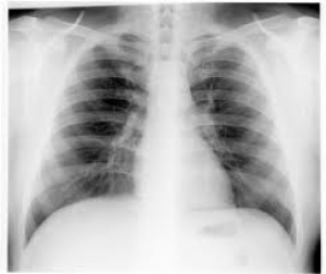 Безплатен преглед на белите дробове