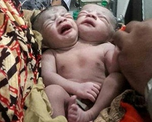 Бебе с две глави се роди в Бангладеш