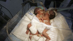 14-годишна роди сиамски близнаци от братовчед си