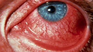 Регистрираха случай на заразяване със зика от сълзите или потта на болен в САЩ