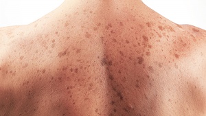 Безплатни прегледи за рак на кожата във ВМА