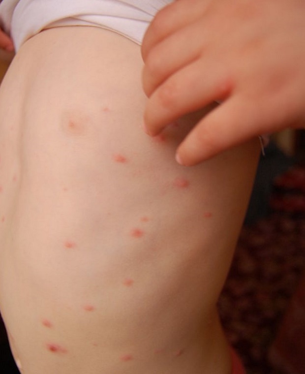 5-годишното дете, прекарало варицела, е в тежко състояние