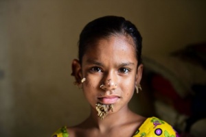 Първи случай на синдрома "човека дърво" при жените в Бангладеш (ВИДЕО)