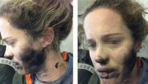 Млада жена пострада, след като слушалките й се взривиха