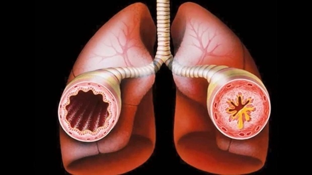 Алерголог: Заболелите от астма в Стара Загора са се увеличи рязко през последните години