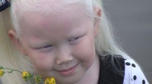 Момиченце албинос набира популярност