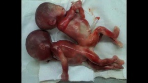 Възможно ли е разделянето на сиамските близнаци от Сливен?