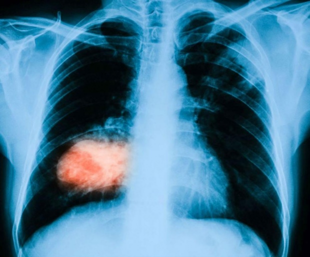 Триизмерна "пътна карта" улеснява откриването на белодробен рак