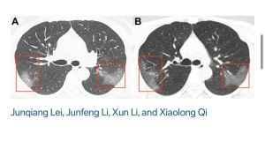 Лекари от Хонконг: Хора, които се възстановяват от коронавируса, може да останат с до 30%по-малко функция на белите дробове
