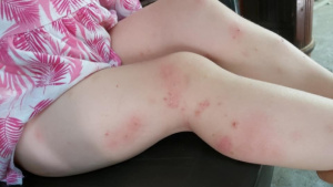 Комари нападнаха Силистра и обезобразиха дете